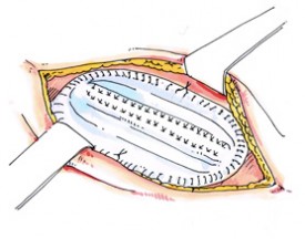 Fixation prothèse pariétale (peut être fixée sous la paroi ou dans la paroi)